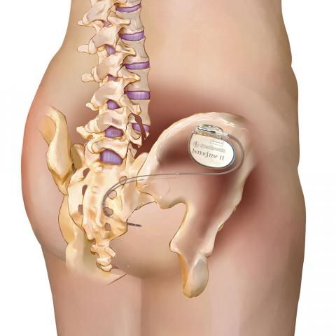 Sacral nerve stimulator placement