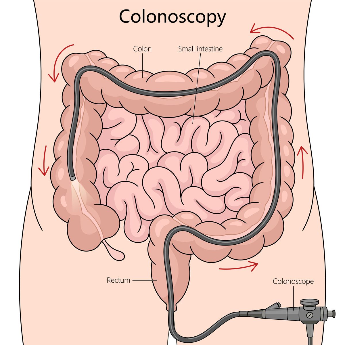 Colonoscopy procedure