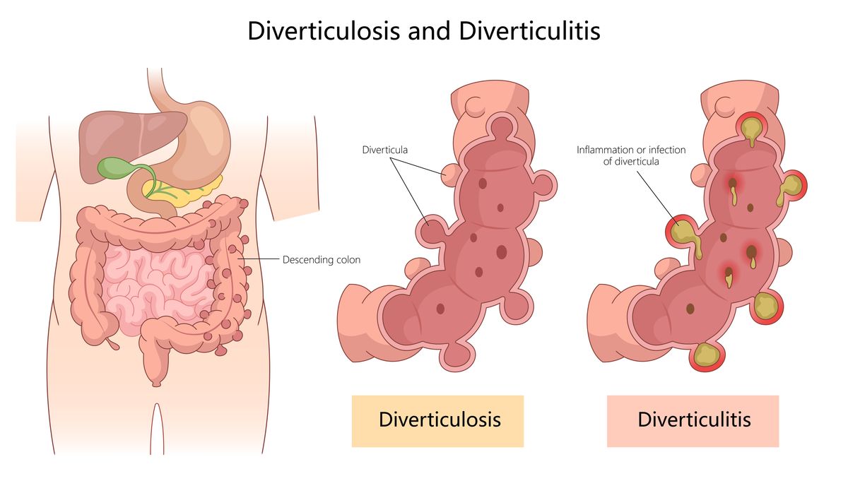 Diverticular disease