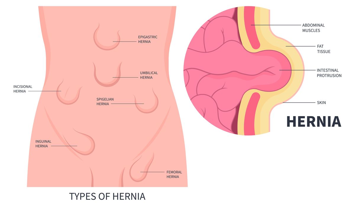 Types of abdominal wall hernias