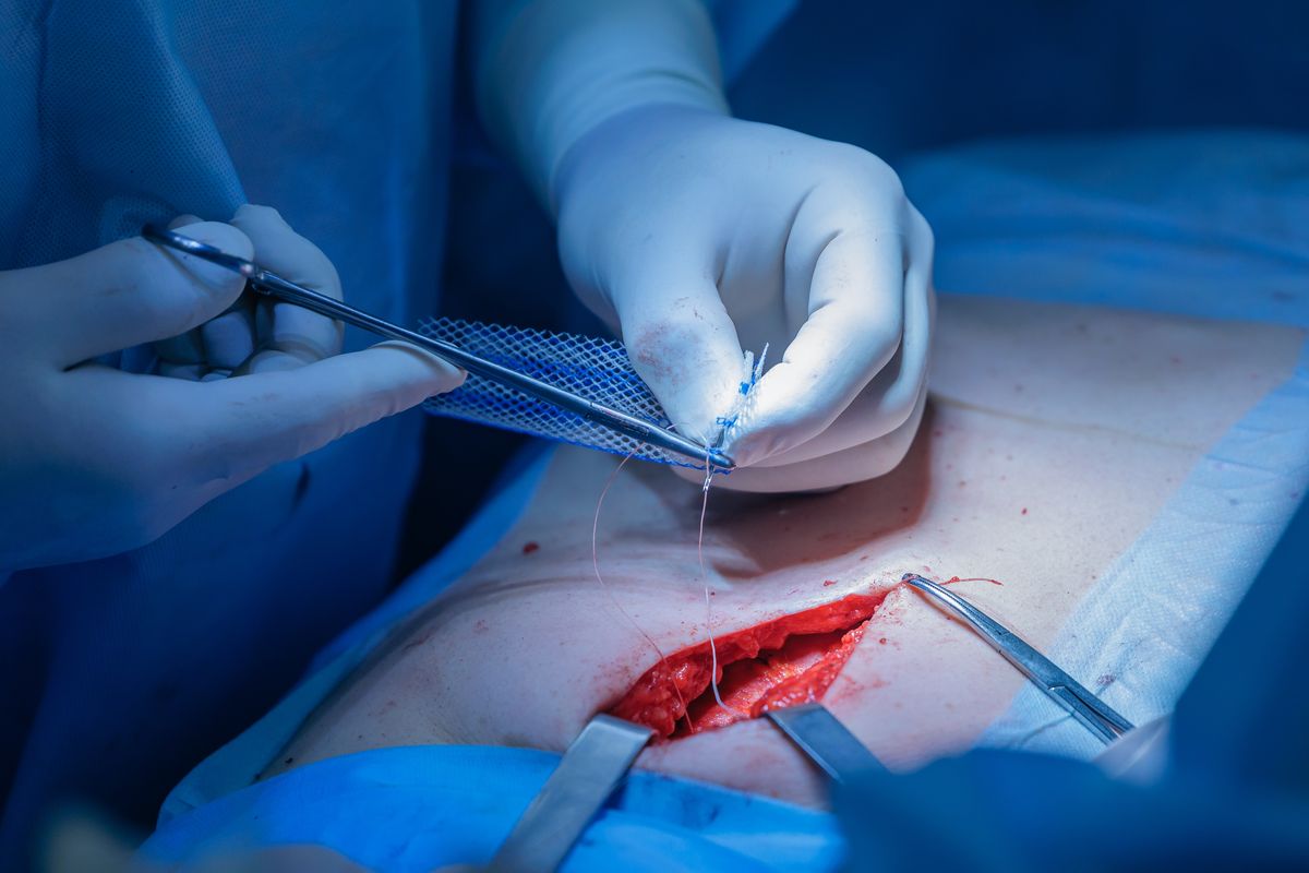 Open surgical procedure
