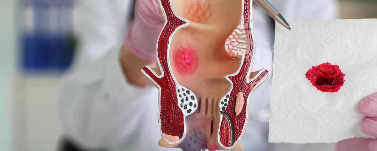 Rectal bleeding assessment