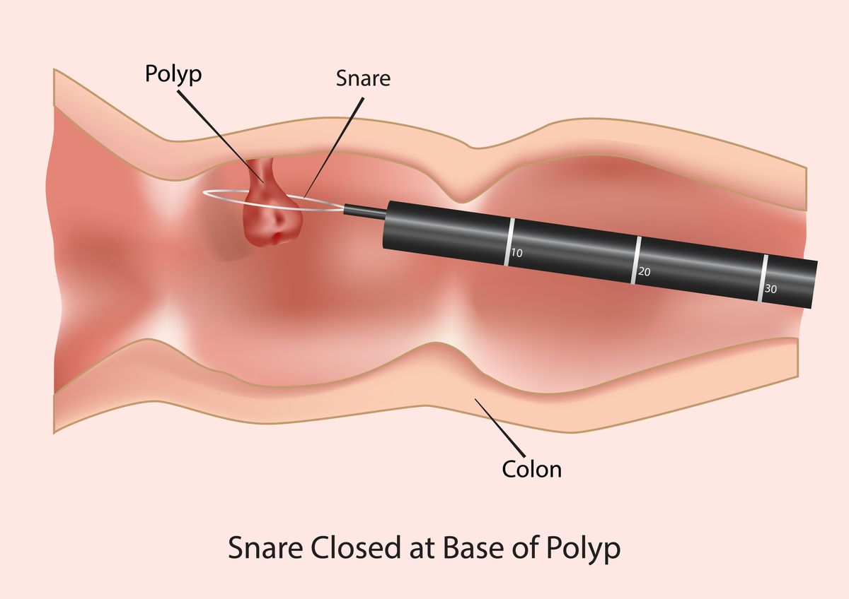 Snaring a polyp during colonoscopy